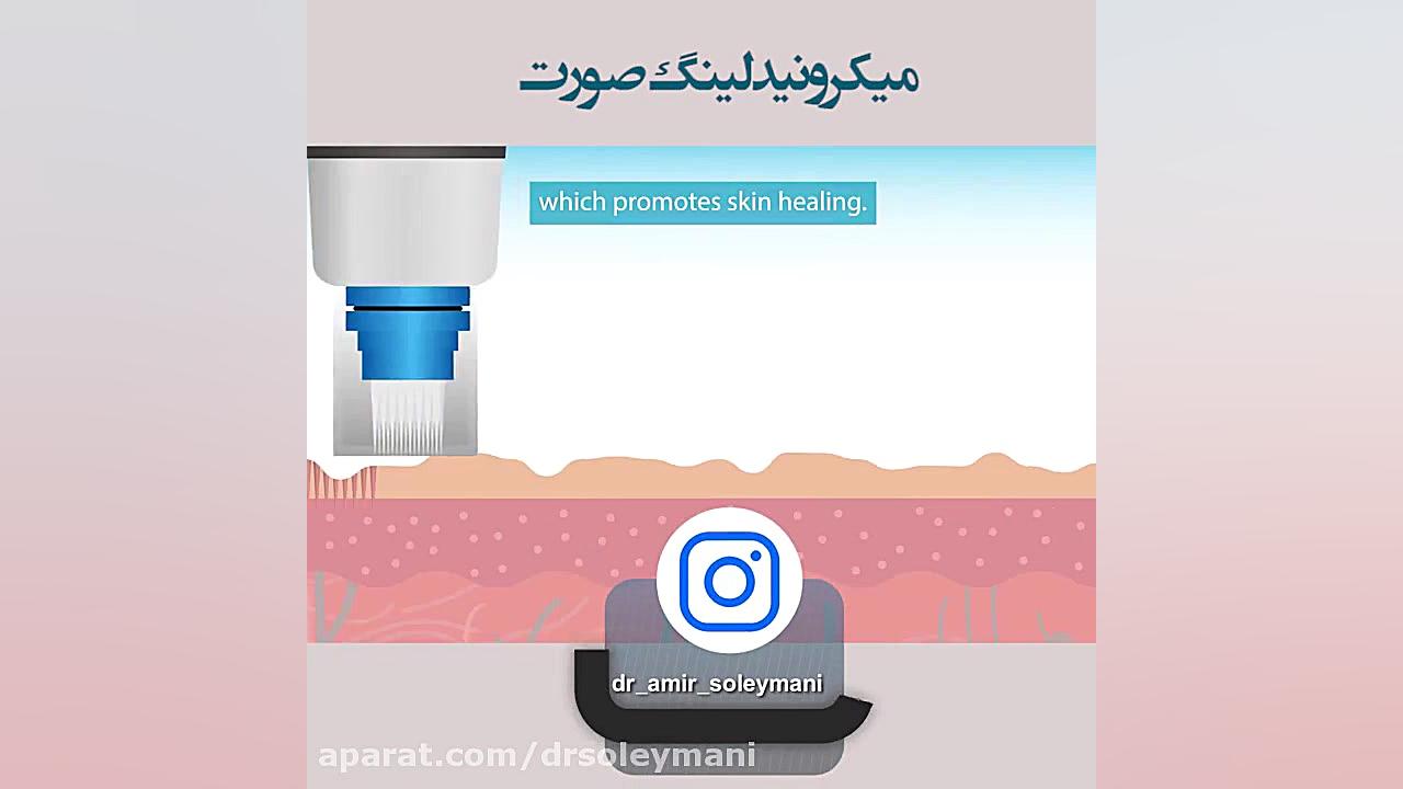 انیمیشن مکانیسم میکرونیدلینگ و تاثیر آن بر پوست دکتر امیر سلیمانی