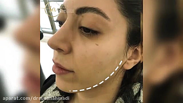 فرم دهی و زاویه سازی صورت با تزریق چربی دکتر سوسن احمدی پیر شهید