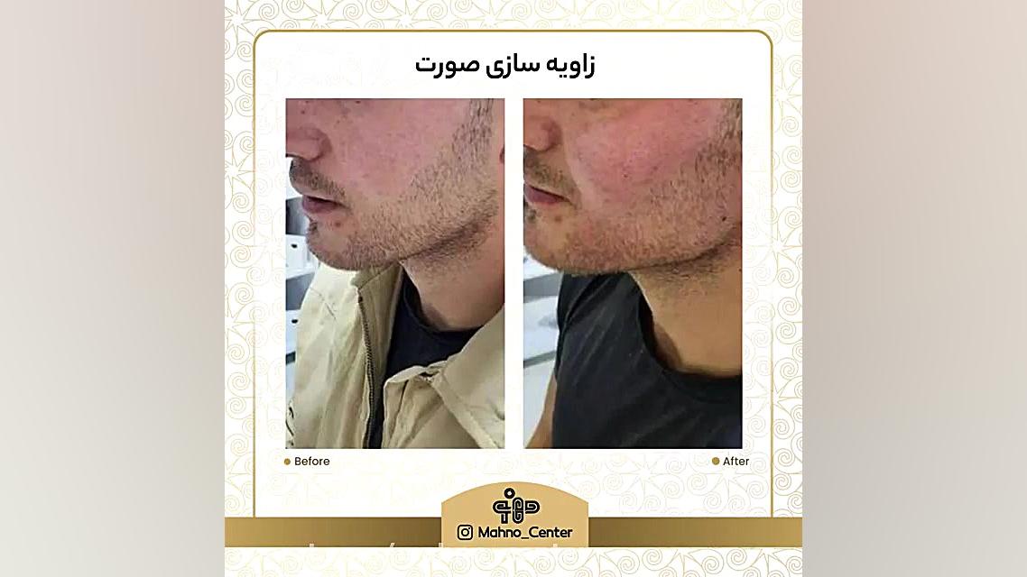 زاویه سازی صورت کلونینگ درمانی