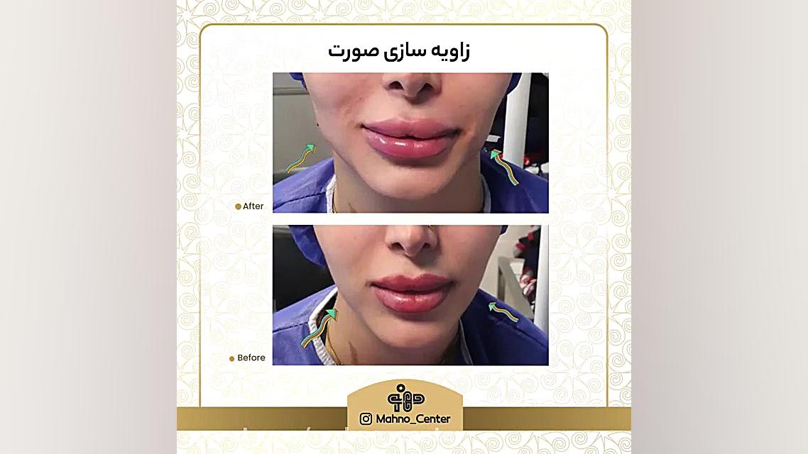 زاویه سازی صورت کاشت ریش