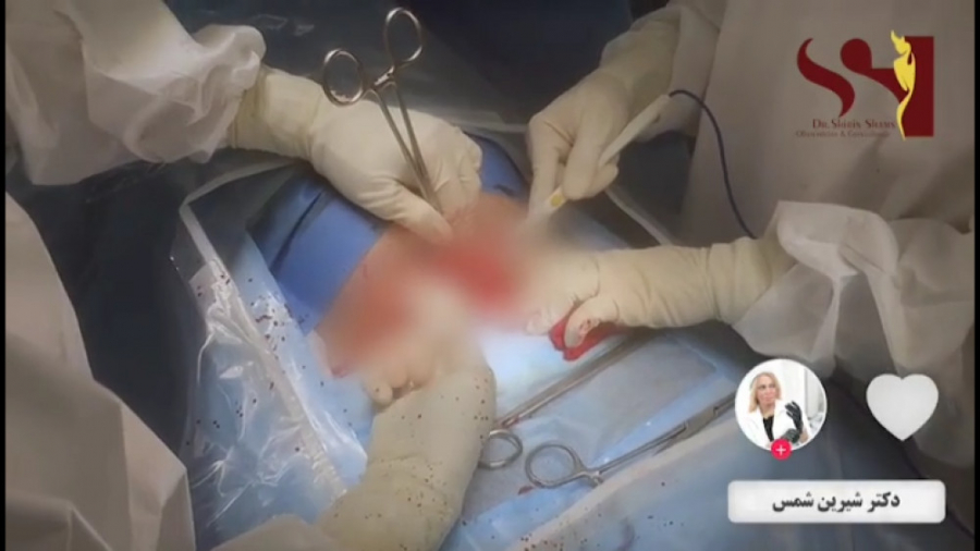 فیلم اتاق عمل زایمان سزارین دکتر شیرین شمس جراح و متخصص زنان و زایمان