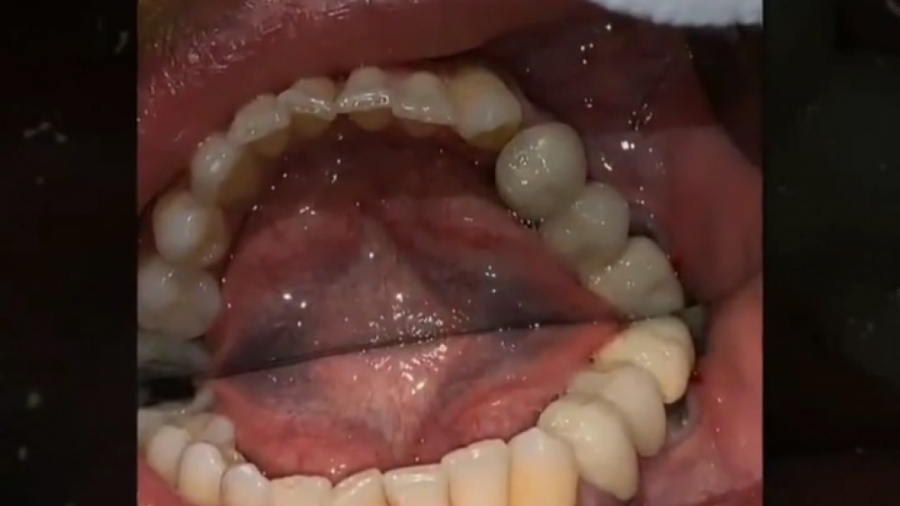 آموزش مدیریت خارج سازی دندان در فک پایین با وجود ضایعه رادیکولار دکتر احسان بیرنگ