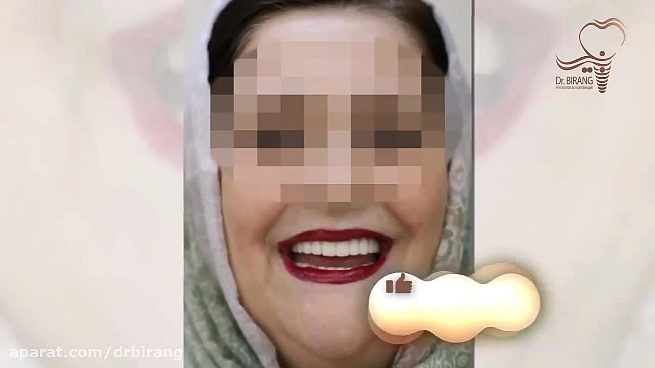 درمان بازسازی کامل دهان با تکنیک ایمپلنت دیجیتال و روکش تمام سرامیک دکتر احسان بیرنگ
