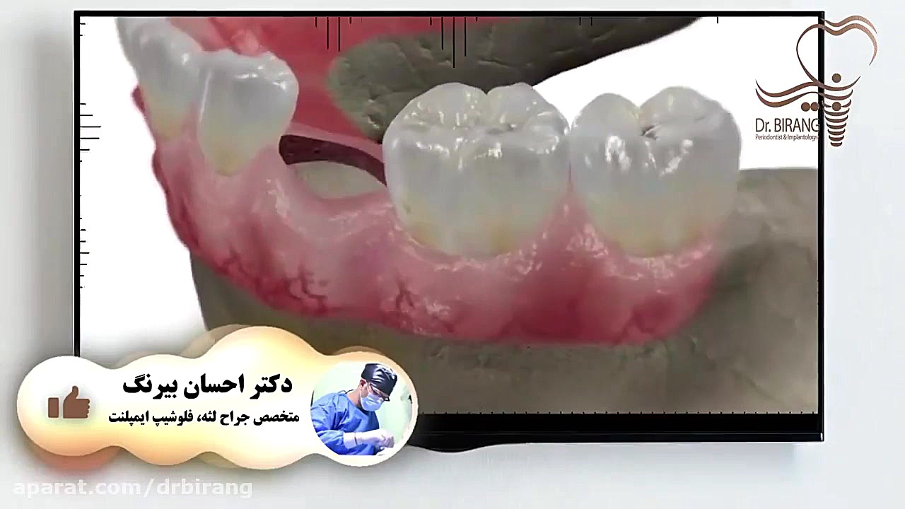 چه کسانی کاندید ایمپلنت هستند؟ دکتر احسان بیرنگ
