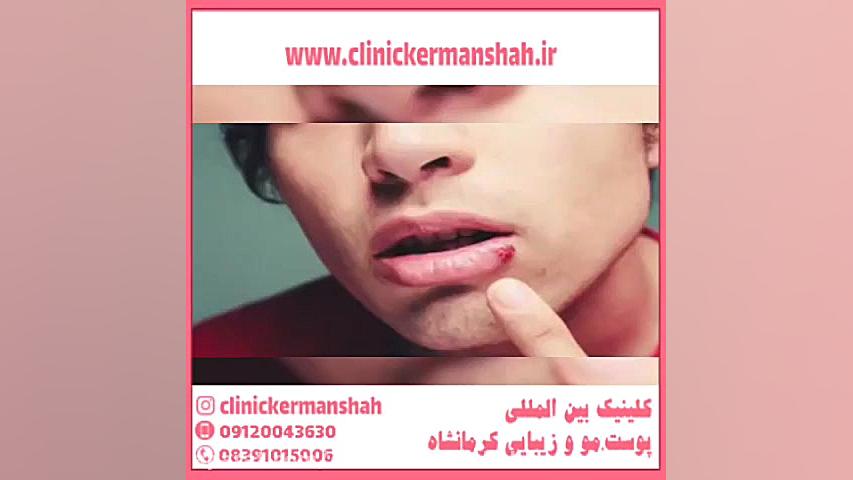 تبخال چیست و چگونه درمان می شود؟ پریودنتیکس