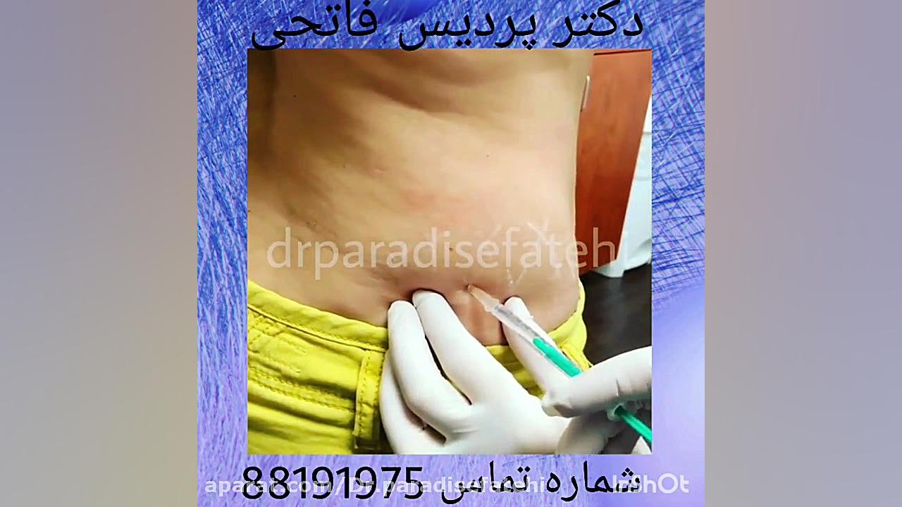 مزوتراپی پهلو پزشکی هیپر باریک