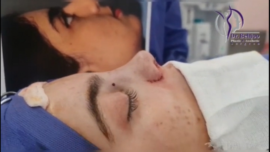 جراحی بینی نیمه فانتزی در اتاق عمل دکتر شاهین بهجو - فوق تخصص جراحی پلاستیک