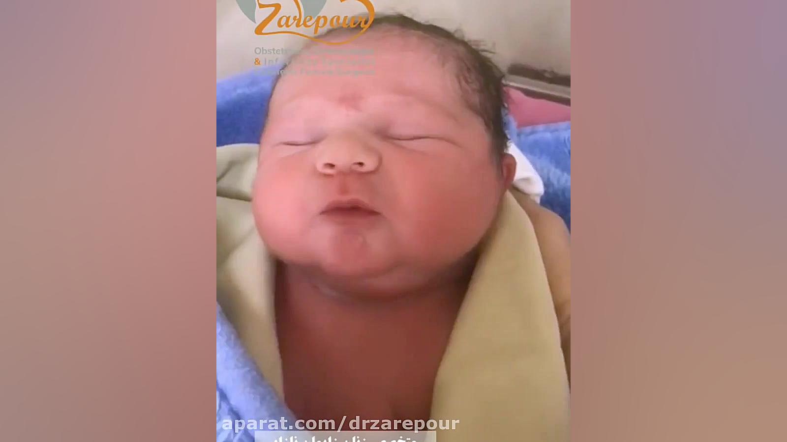 زایمان اورژانسی در هفته 37 بارداری از مادر مبتلا به دیابت کاشت ابرو