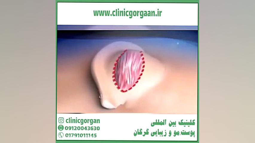 اتوپلاستی چیست و چگونه انجام می شود؟ کربوکسی تراپی