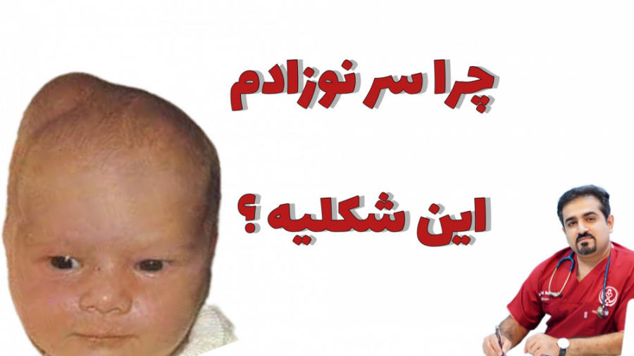 بد شکلی های سر نوزاد در بدو تولد ( نوزادان سالم ) جواد عزتی