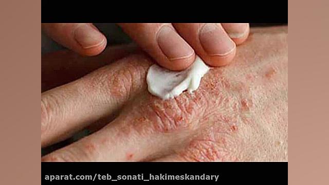 نسخه گیاهی درمان پوست و مو در طب سنتی حکیم اسکندری دکتر پوست