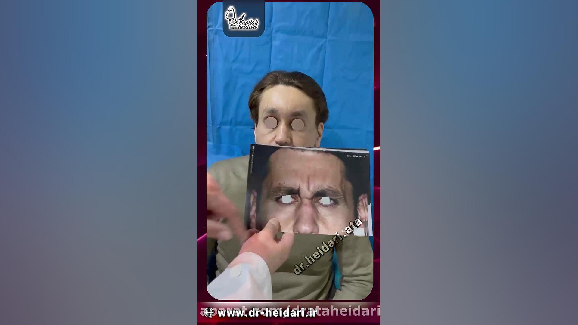 لیفت کامل صورت و گردن و لیفت آندوسکوپی پیشانی مزوتراپی