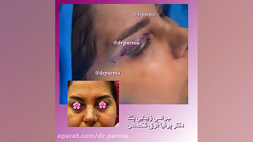 فیلم واقعی جراحی زیبایی پلک دکتر رفیع پرنیا فوق تخصص پلاستیک