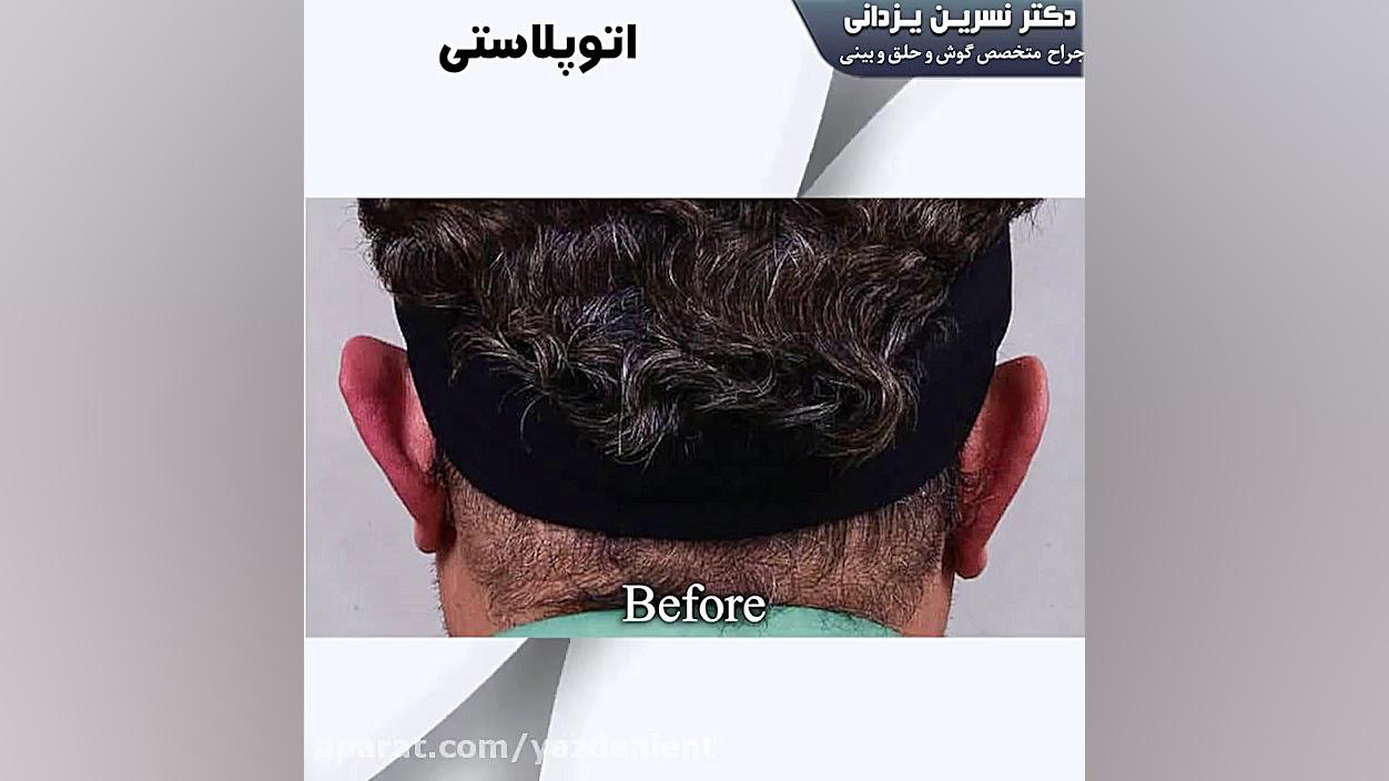 اتوپلاستی یا جراحی زیبایی گوش آزمون آنتی‌بادی خنثی‌کننده