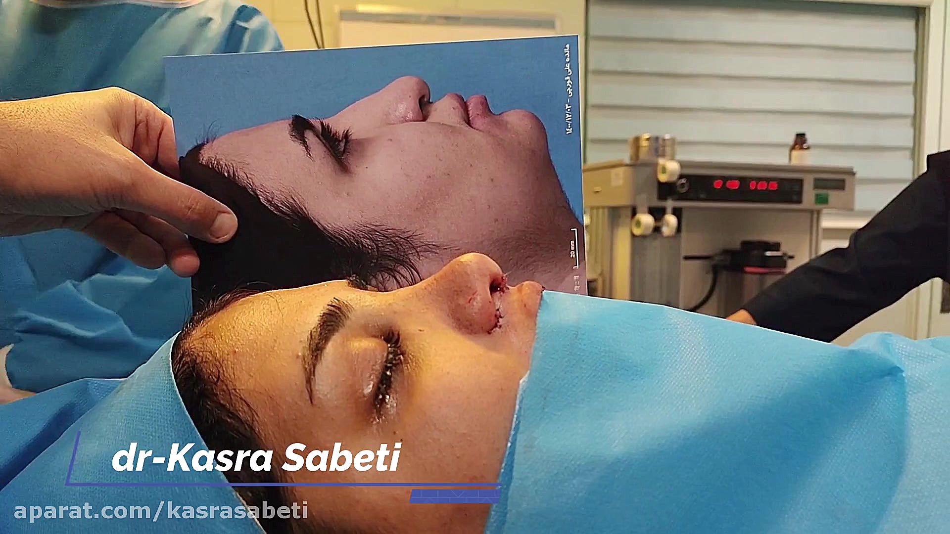 عمل بینی با افتادگی شدید -این ویدیو دارای صحنه اتاق عمل است -دکتر ثابتی درمان جای جوش