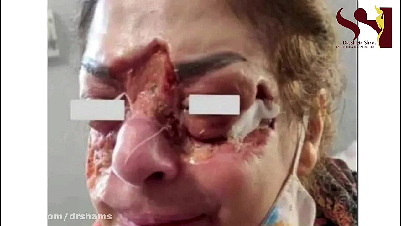 تزریق ژل در آرایشگاه!!!!! دکتر شیرین شمس جراح و متخصص زنان و زایمان
