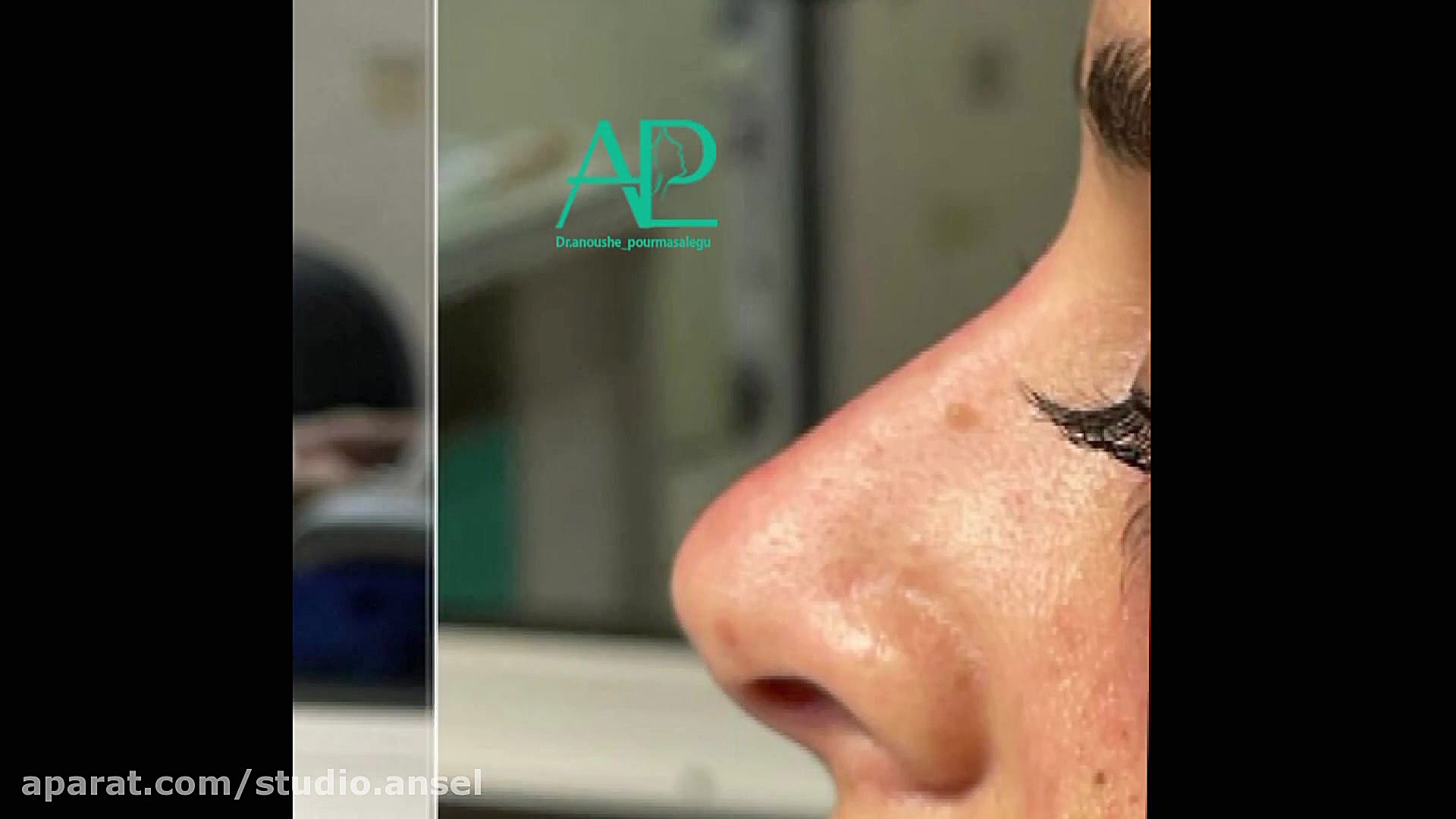 بهترین کلینیک زیبایی در رشت.فیلر بینی.تزریق ژل .بوتاکس در رشت ترمیم زیبایی دندان