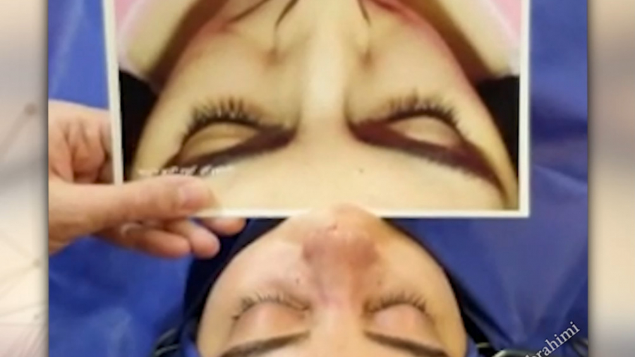 جراحی انحراف بینی استخوانی توسط بهترین جراح بینی در تهران دکتر امید ابراهیمی