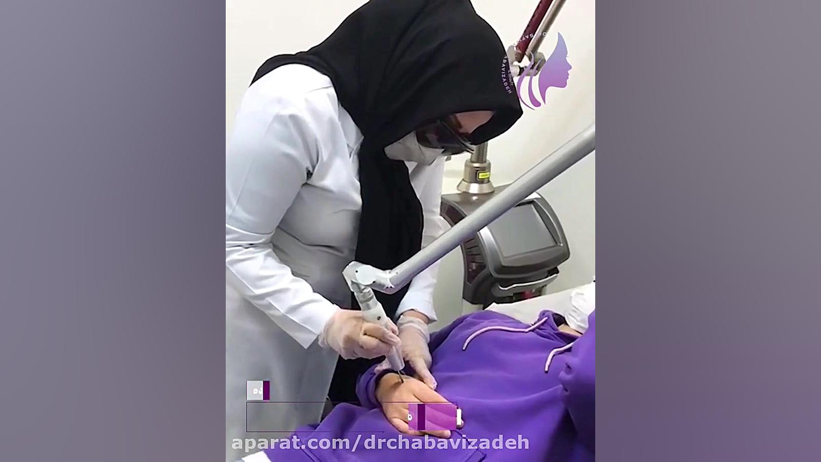 ریمو تاتو با لیزر کیوسوئیچ دکتر صفیه چعباوی زاده