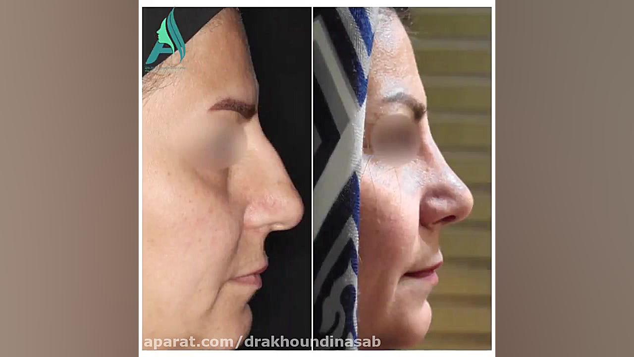 جراحی زیبایی بینی دکتر محمدرضا آخوندی نسب-فوق تخصص جراحی پلاستیک