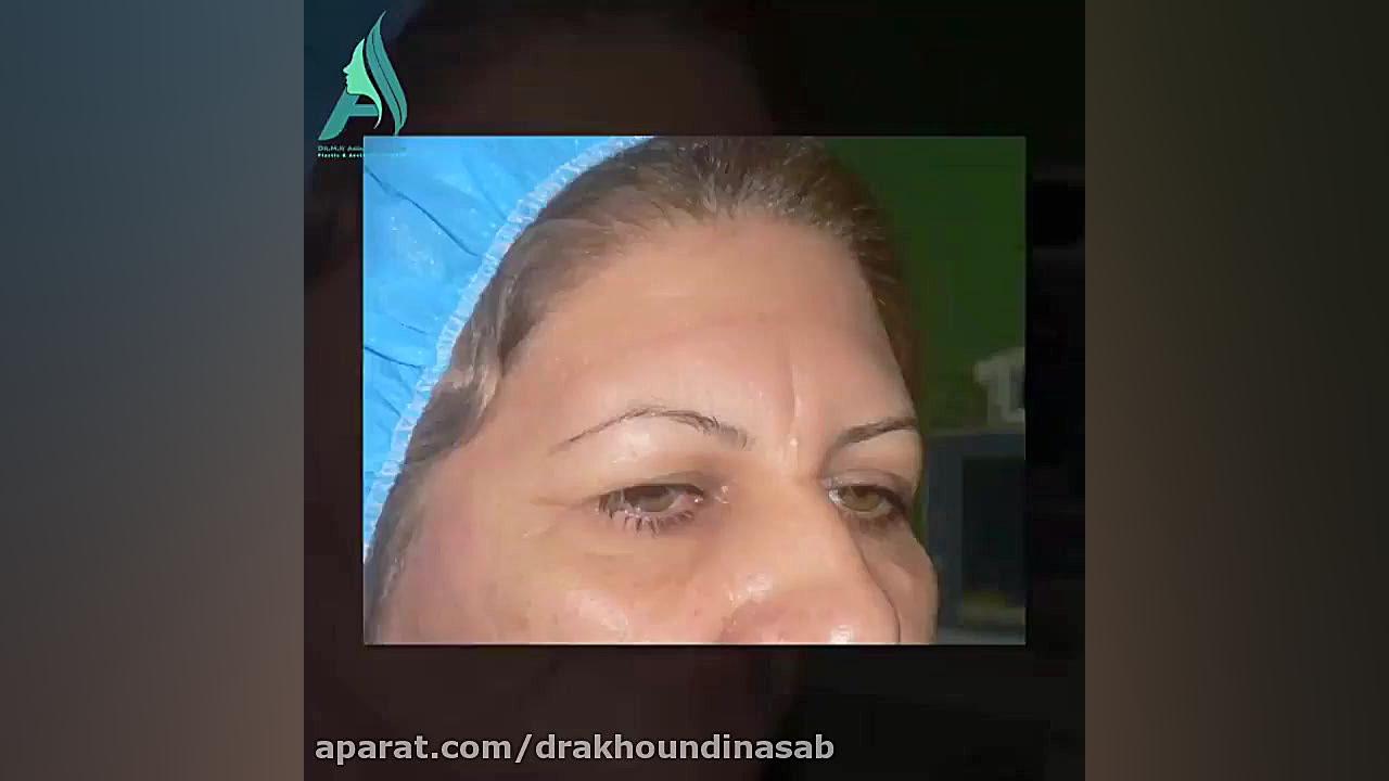 لیفت آندوسکوپی پیشانی دکتر محمدرضا آخوندی نسب-فوق تخصص جراحی پلاستیک