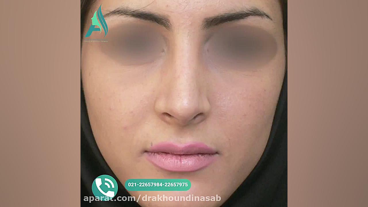 جراحی بینی غضروفی به صورت طبیعی دکتر محمدرضا آخوندی نسب-فوق تخصص جراحی پلاستیک