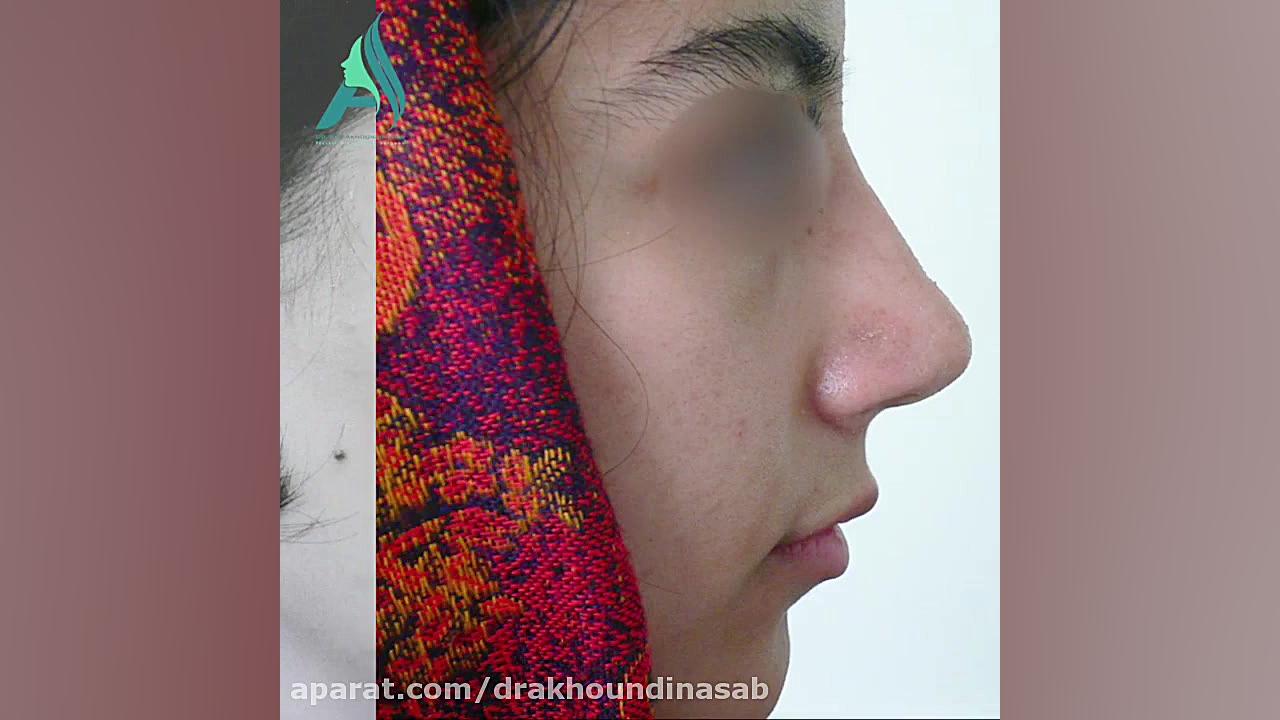 جراحی بینی غضروفی دکتر محمدرضا آخوندی نسب-فوق تخصص جراحی پلاستیک