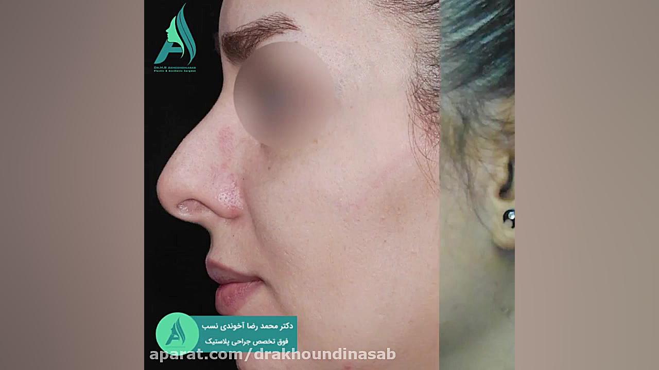 جراحی بینی غضروفی به صورت نیمه فانتزی دکتر محمدرضا آخوندی نسب-فوق تخصص جراحی پلاستیک