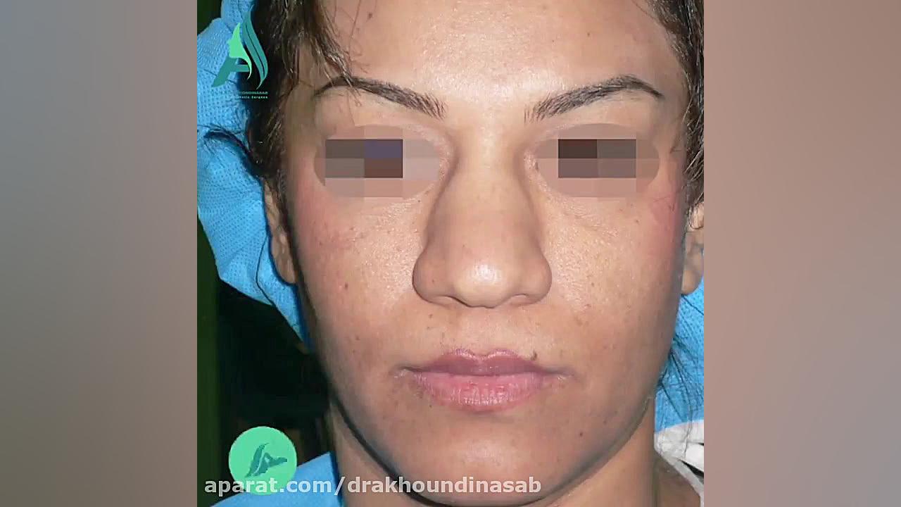 جراحی زیبایی بینی گوشتی دکتر محمدرضا آخوندی نسب-فوق تخصص جراحی پلاستیک