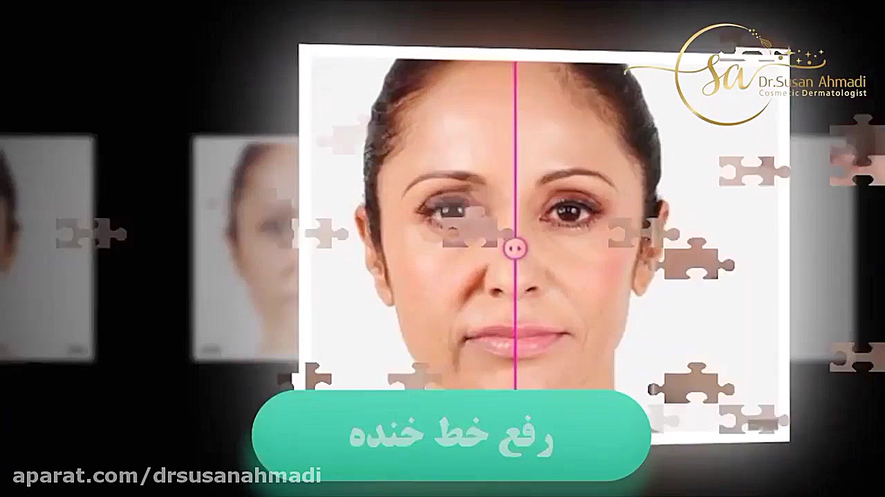 تزریق ژل و فیلر برای خط خنده دکتر سوسن احمدی پیر شهید