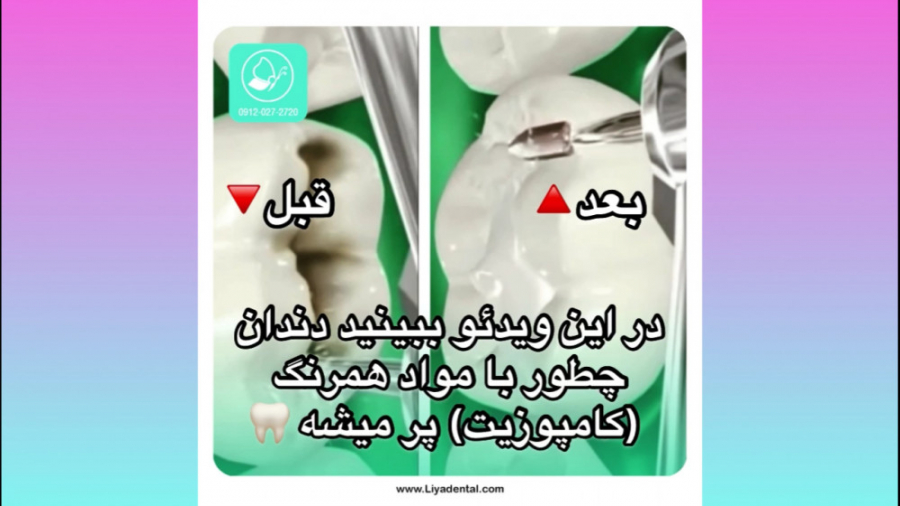 پر کردن دندان (ترمیم) در کلینیک دندانپزشکی لیا هایپررفلکسی
