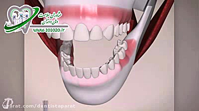 سفید کردن دندان با استفاده از لیزر درمان سلول‌های بنیادی