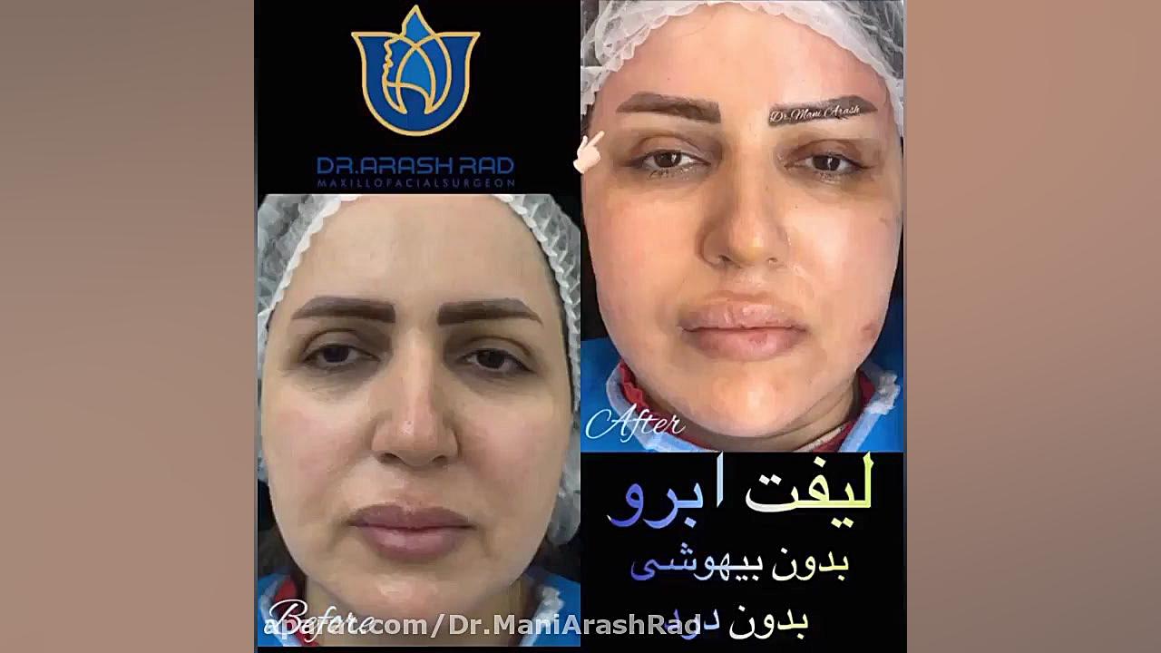 لیفت ابرو (لیفت شقیقه) دکتر مانی آرش راد جراح فك و صورت