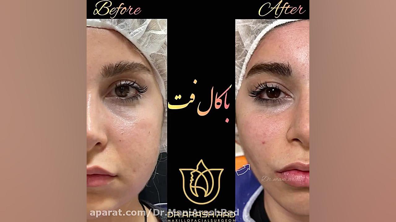 باکال فت دکتر مانی آرش راد جراح فك و صورت