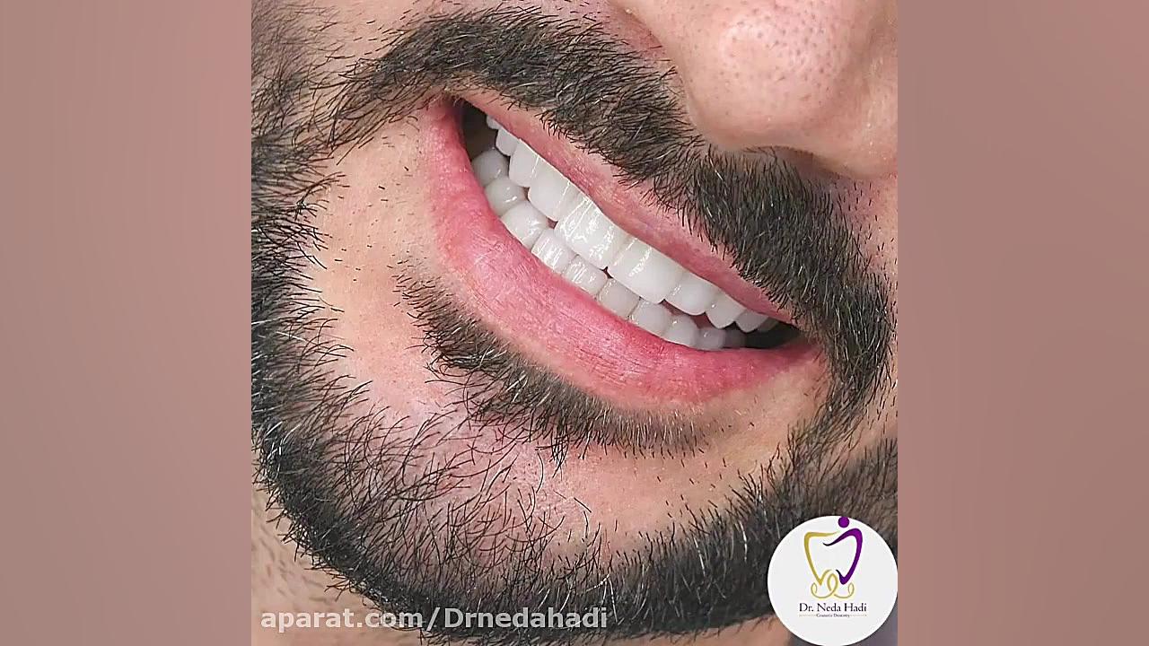 فیلم واقعی از کامپوزیت دندان دکتر ندا هادی-دندانپزشک زیبایی