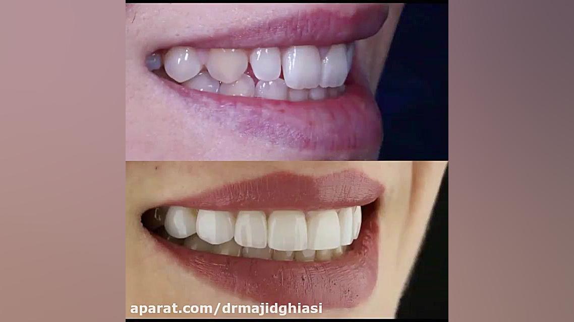 اصلاح طرح لبخند دکترمجیدقیاسی