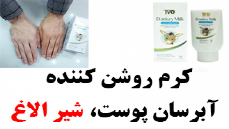 کرم روشن کننده و آبرسان پوست، شیر الاغ Donkey milk بیماری آلبومینوری وراثتی