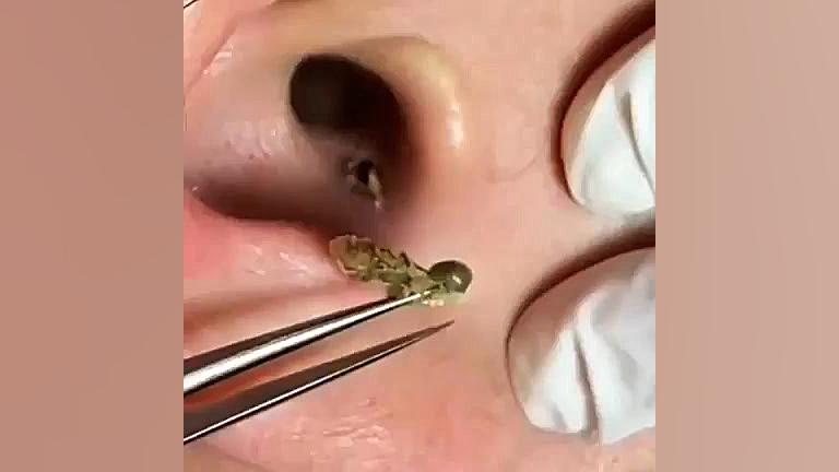 خارج کردن جوش چرکی از داخل گوش لیپوماتیک