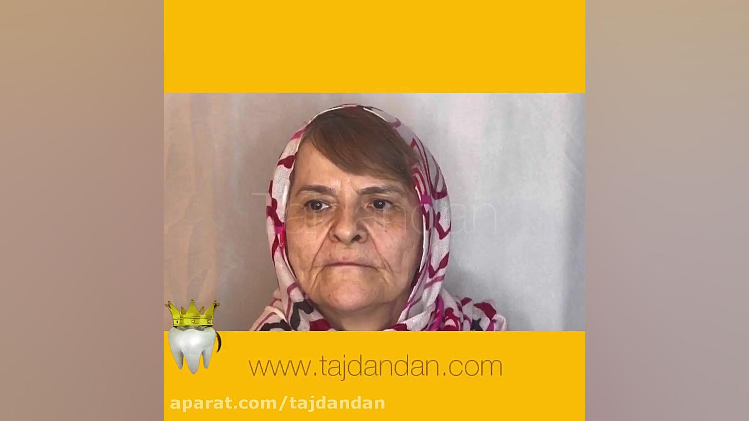 ساخت دندان مصنوعی برای افراد بدون لثه در لابراتوار دندانسازی تاج دیسمورفی فاسیال