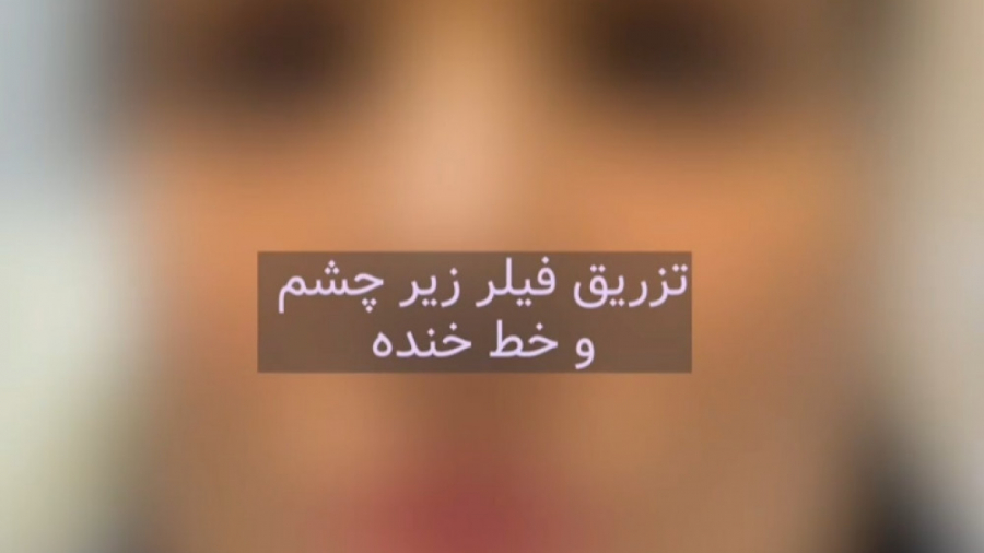 فیلم تزریق فیلر زیر چشم دکتر سار ا لطفی