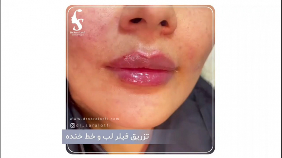 فیلم تزریق فیلر لب و خط خنده زمان28ثانیه