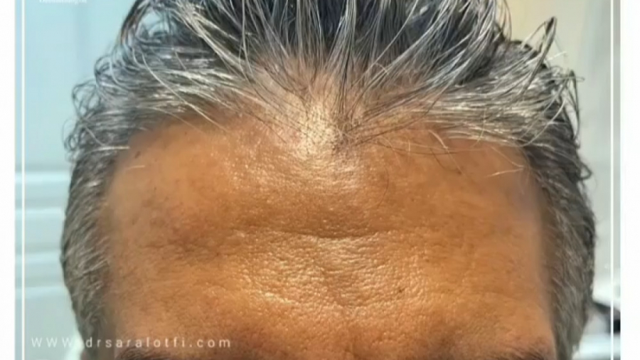 فیلم فیلر پیشانی جهت رفع خطوط دکتر سار ا لطفی