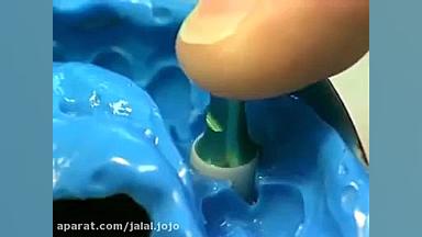 مراحل ایمپلنت دندان کلینیک دندانپزشکی مریم مشهد هایپوفلکسی