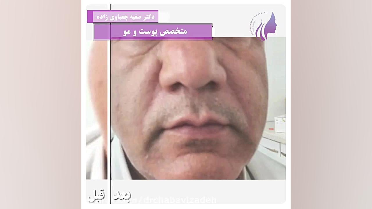 نمونه تزریقات فیلر دکتر چعباوی زاده دکتر صفیه چعباوی زاده