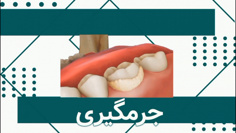 جرمگیری میکروالکترود آرایه‌ای