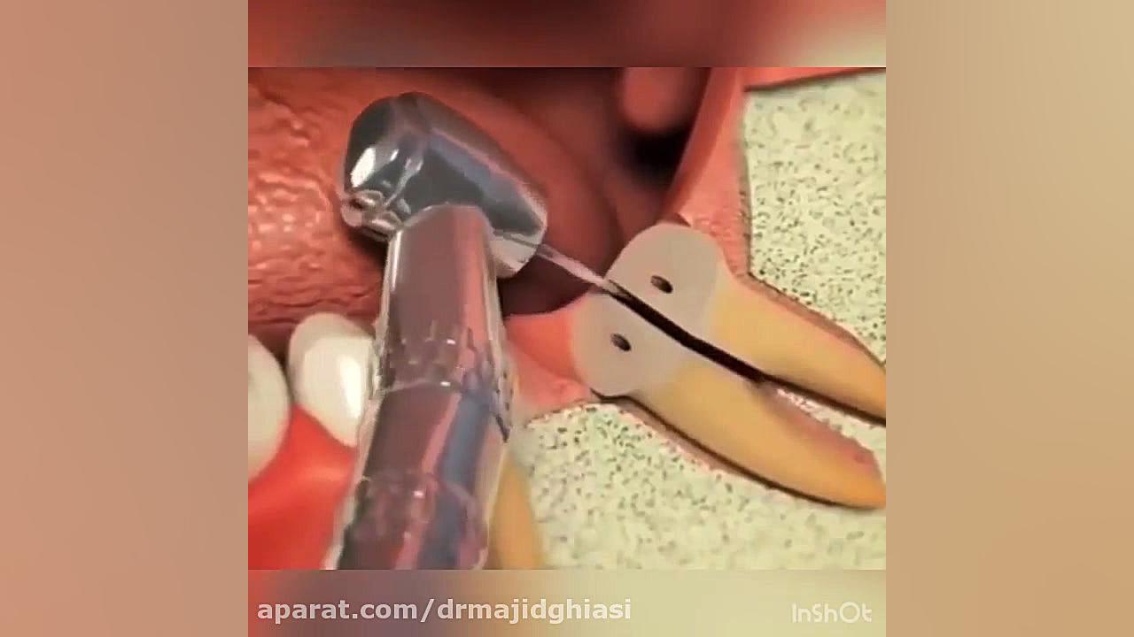 جراحی دندان عقل نیمه نهفته دکترمجیدقیاسی
