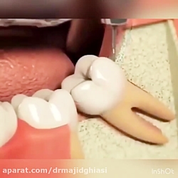 جراحی دندان عقل نیمه نهفته