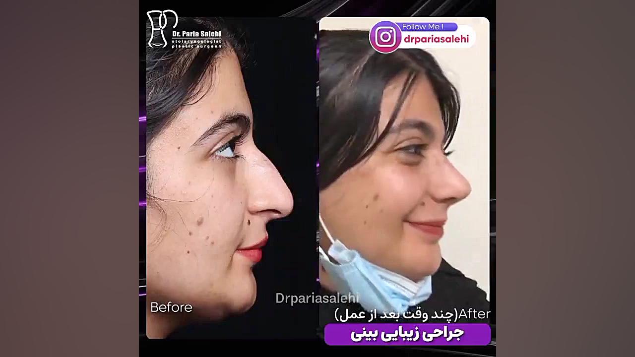 یک ماه بعد از جراحی زیبایی بینی در تهران دکتر پریا صالحی ✔ بهترین جراح بینی تهران