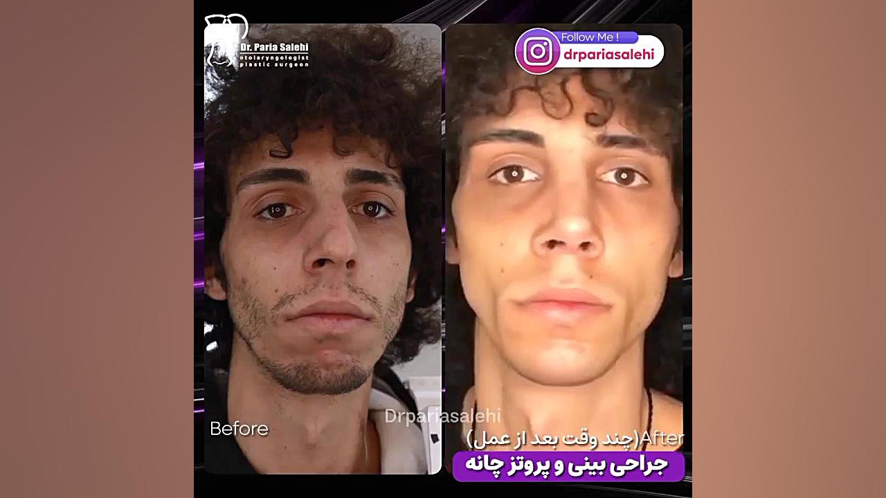 بیشترین تغییر تنها با جراحی بینی و پروتز چانه دکتر پریا صالحی ✔ بهترین جراح بینی تهران
