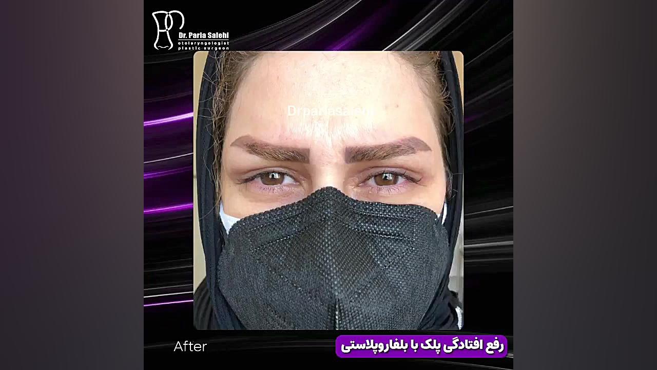 رفع افتادگی پلک با بلفاروپلاستی دکتر پریا صالحی ✔ بهترین جراح بینی تهران